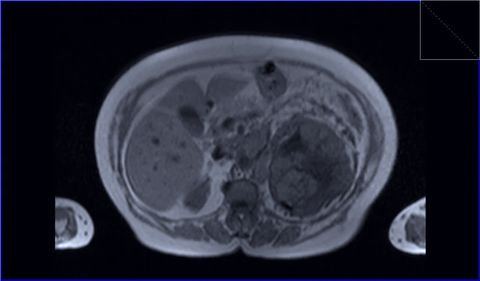 Renal cancer imaging for procedure planning
