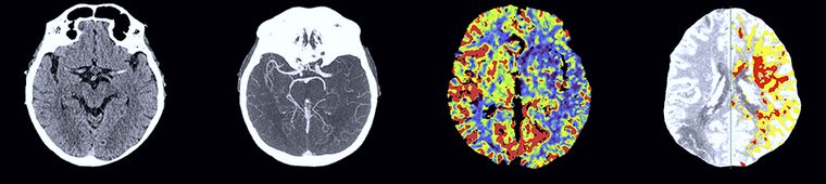 Acute stroke brain imaging series
